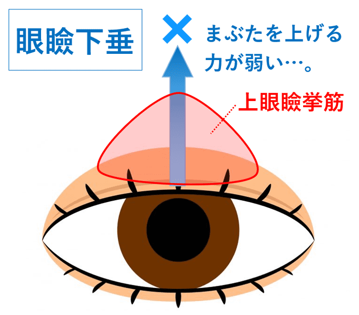 眼瞼下垂