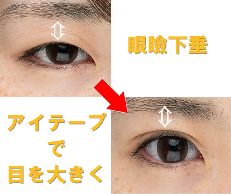 眼瞼下垂 アイテープ