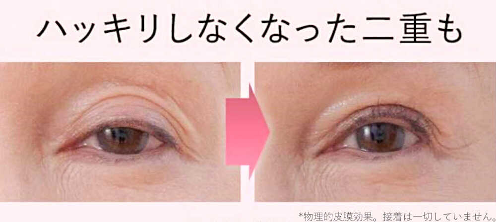 ptosis and large eyes